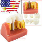 190891420923 Denshine Dental Demonstration Teeth Model Removable Implant Crown