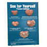 79737 Health Edco See For Yourself Prostate Conditions Easel Display Model