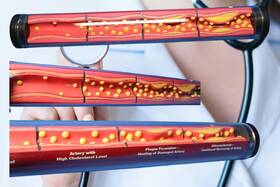 75069 Health Edco Education Silent Destruction How High Cholesterol Destroys Arteries