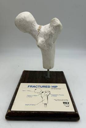 84080 Health Edco Fractured Hip Femur Bone Education Anatomical Model