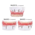Dental Teeth Model Demo Overdenture Restoration With 2 / 4 Implants. Fixed Price $32.29.