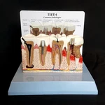 Anatomical Diseased Teeth And Gums Model - Dental Hygiene Medical Tooth Anatomy. Fixed Price $50.26.